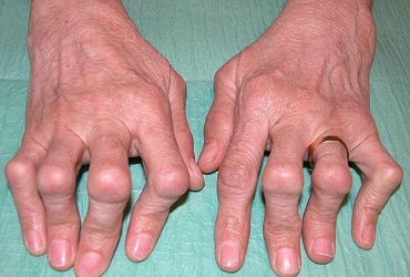 Артрит – серьезное воспалительное заболевание суставов.
